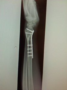 A side view X-Ray of my left fore-arm, a few months after the accident.