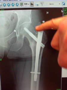 My surgeon reviews my X-ray of my hip at a follow up visit months after the accident.